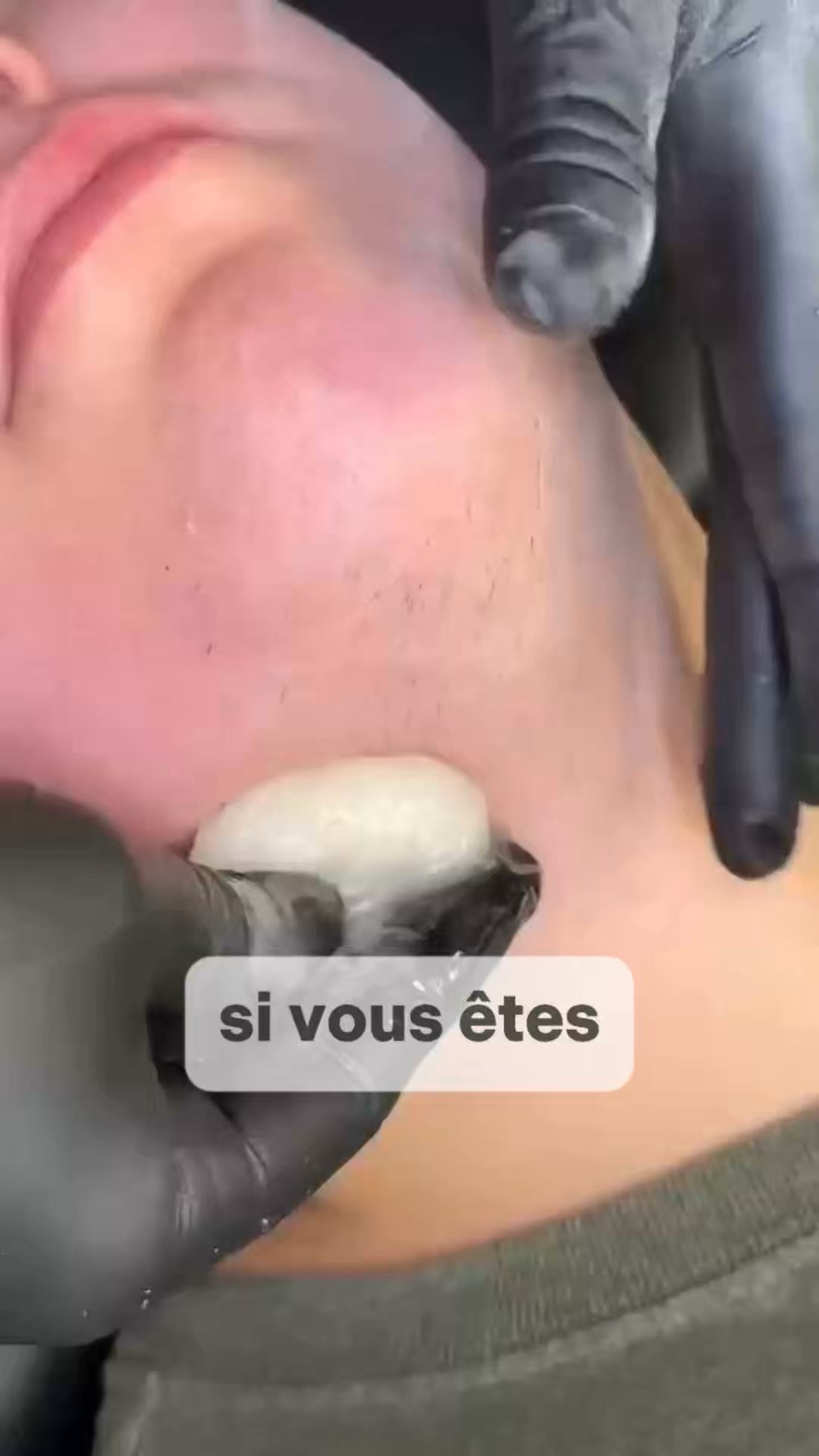 Empêchez vos poils du menton de repousser.
