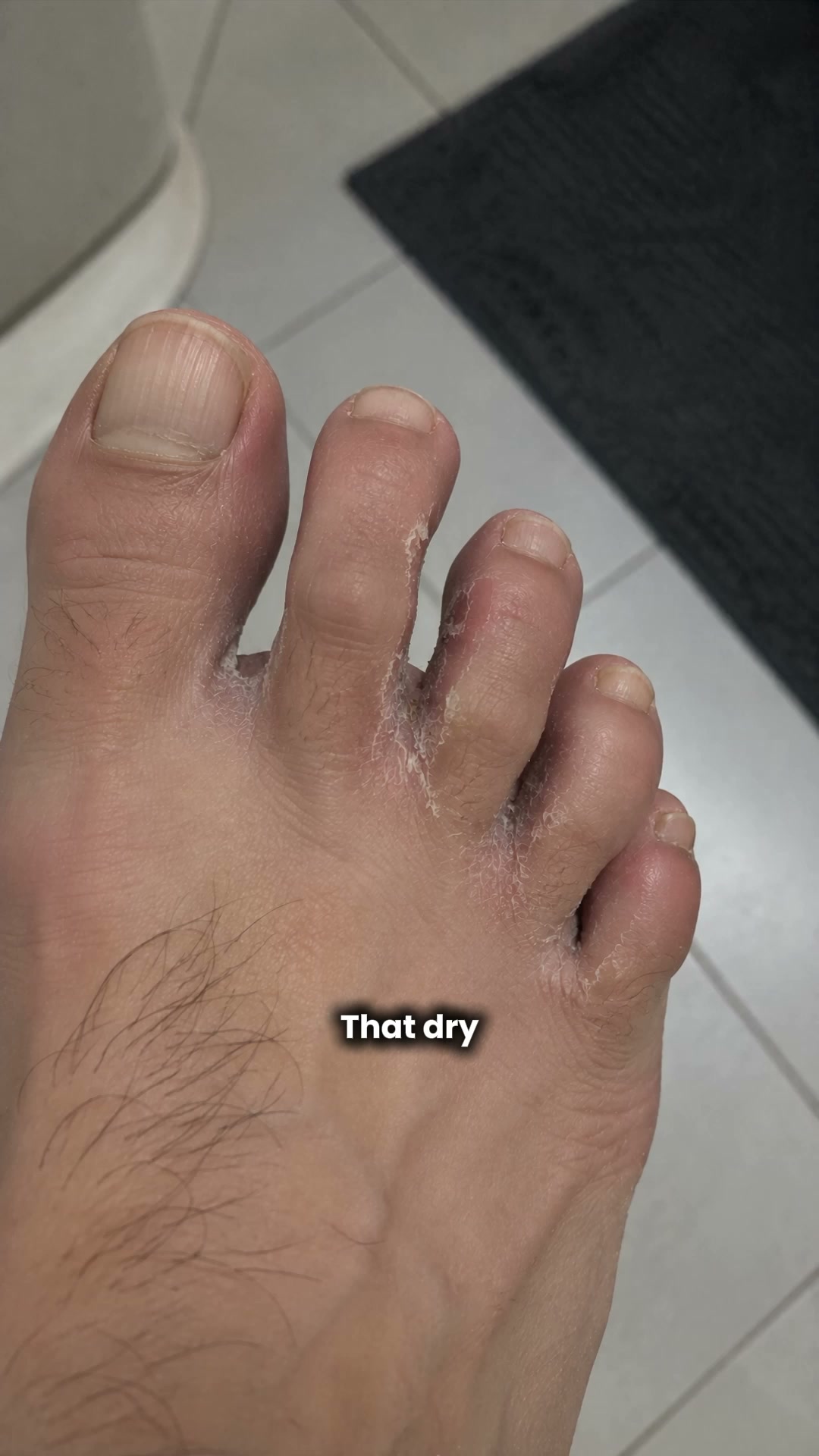 Goodbye Athlethe’s foot