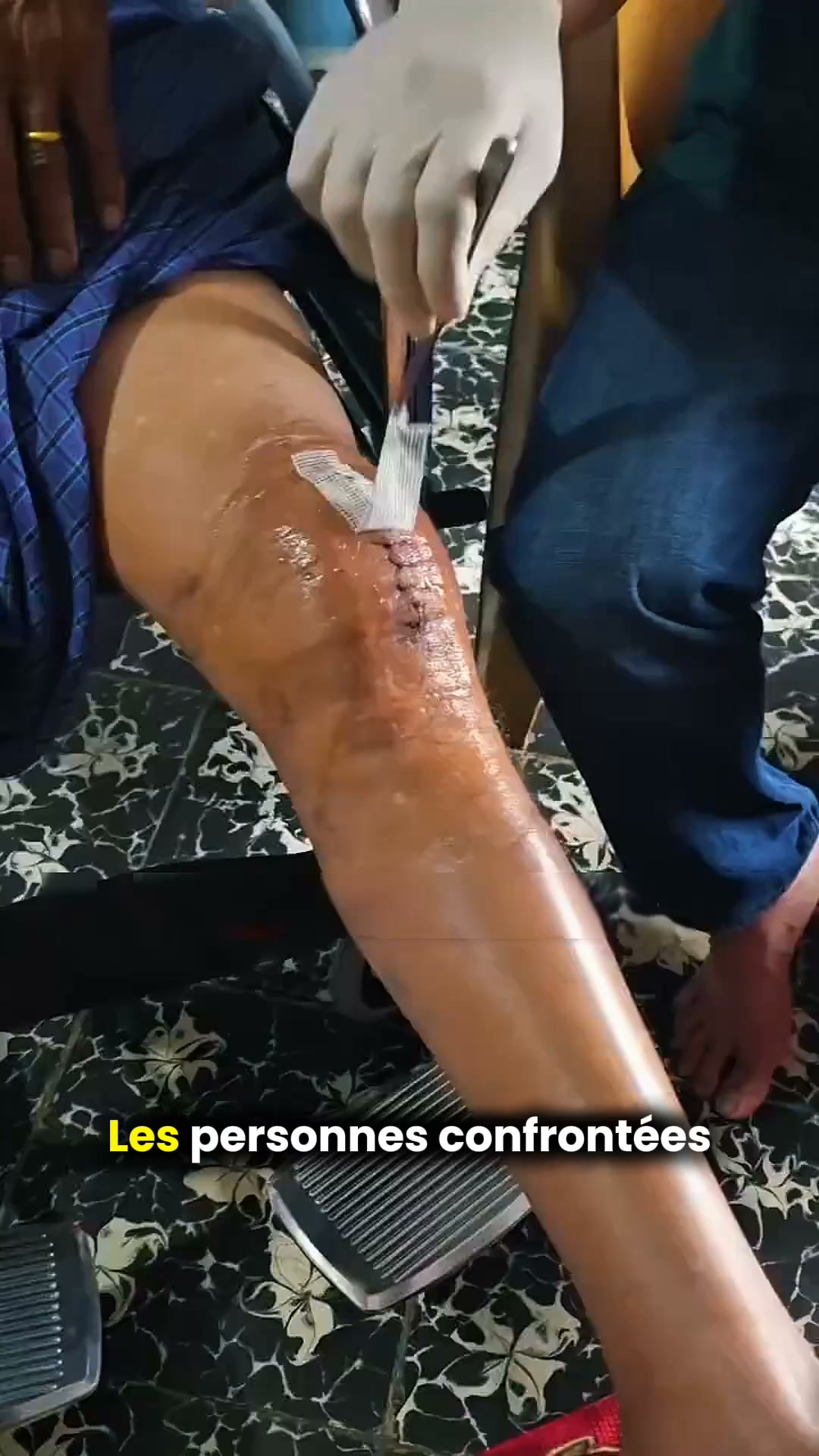 Douleurs au genou ou arthrose ?
