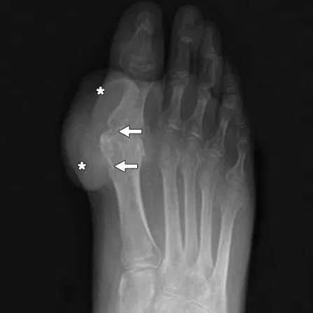 Five Years Of Gout Fear