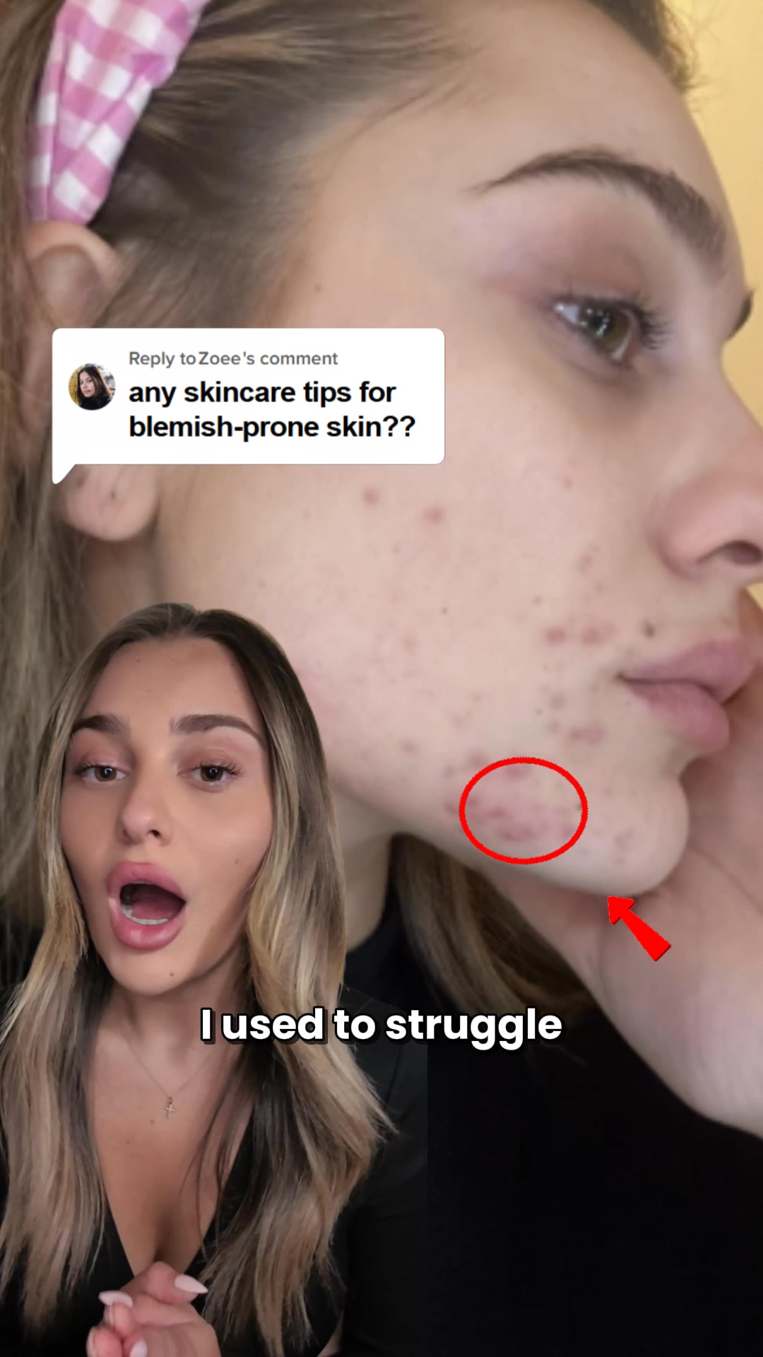 Clearer skin in 12 weeks