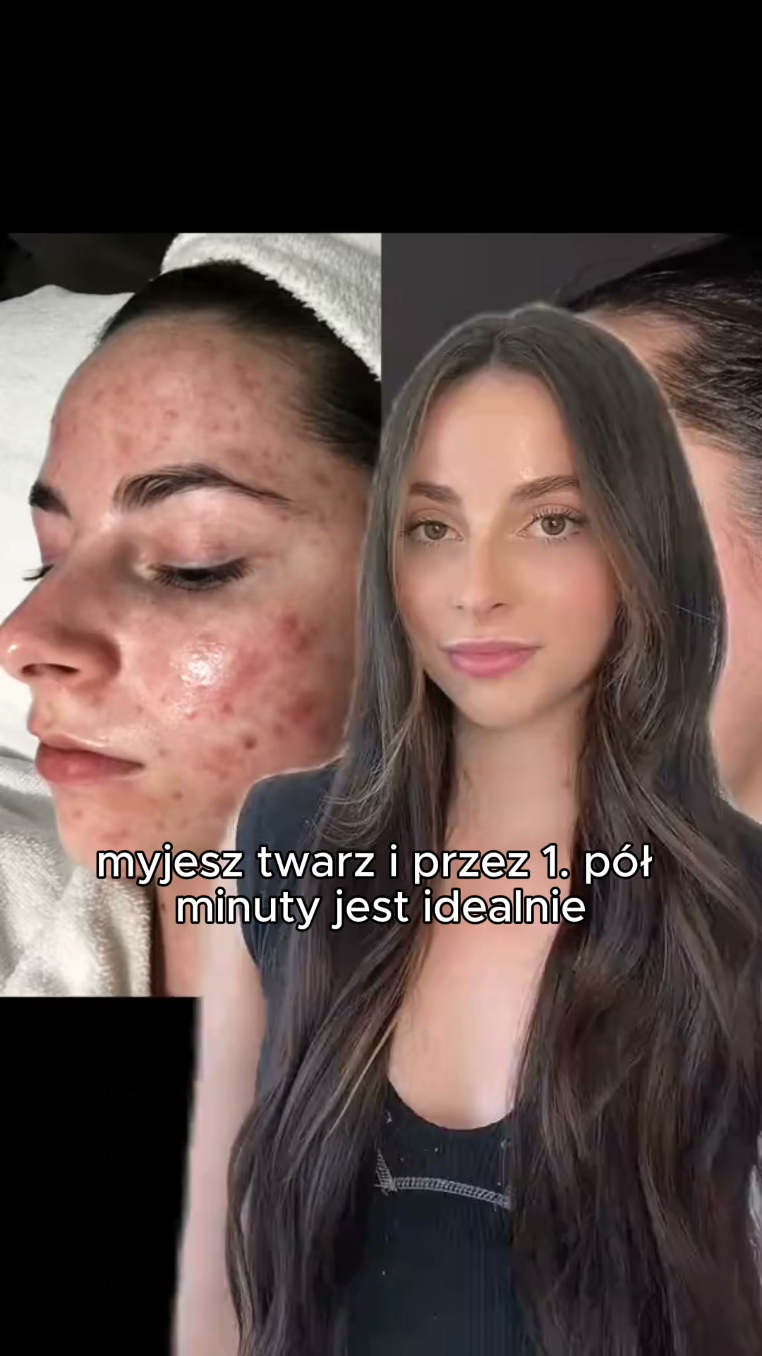 Rytuał 3 kroków na wypryski