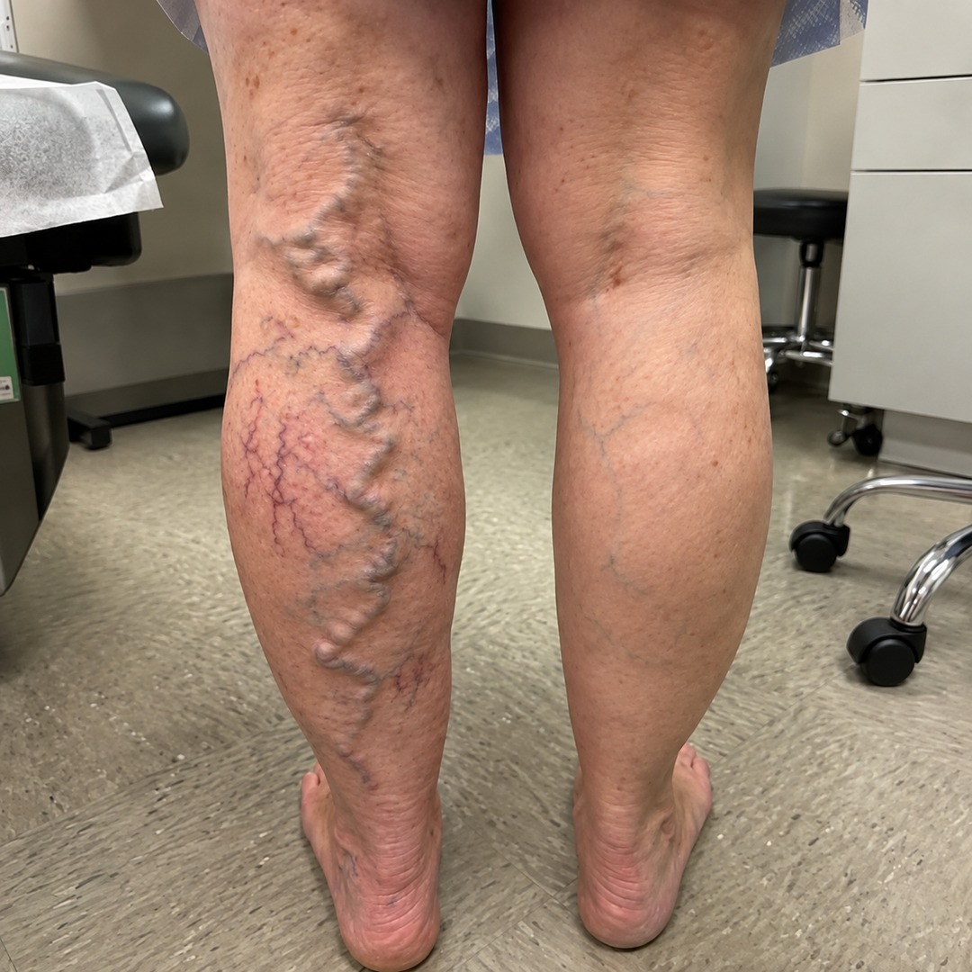 No More Varicose & Spider Veins