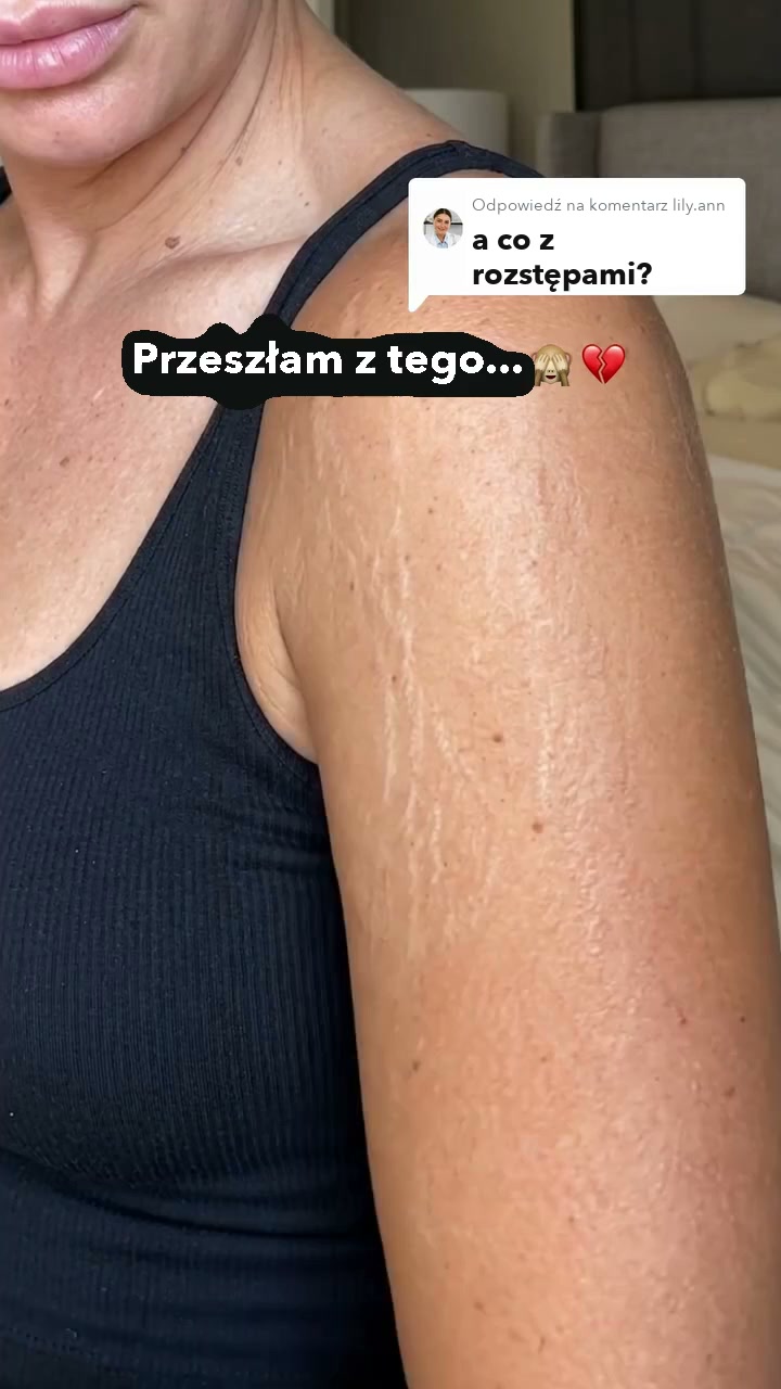 Dzień 1 i dzień 7 moich rozstępów