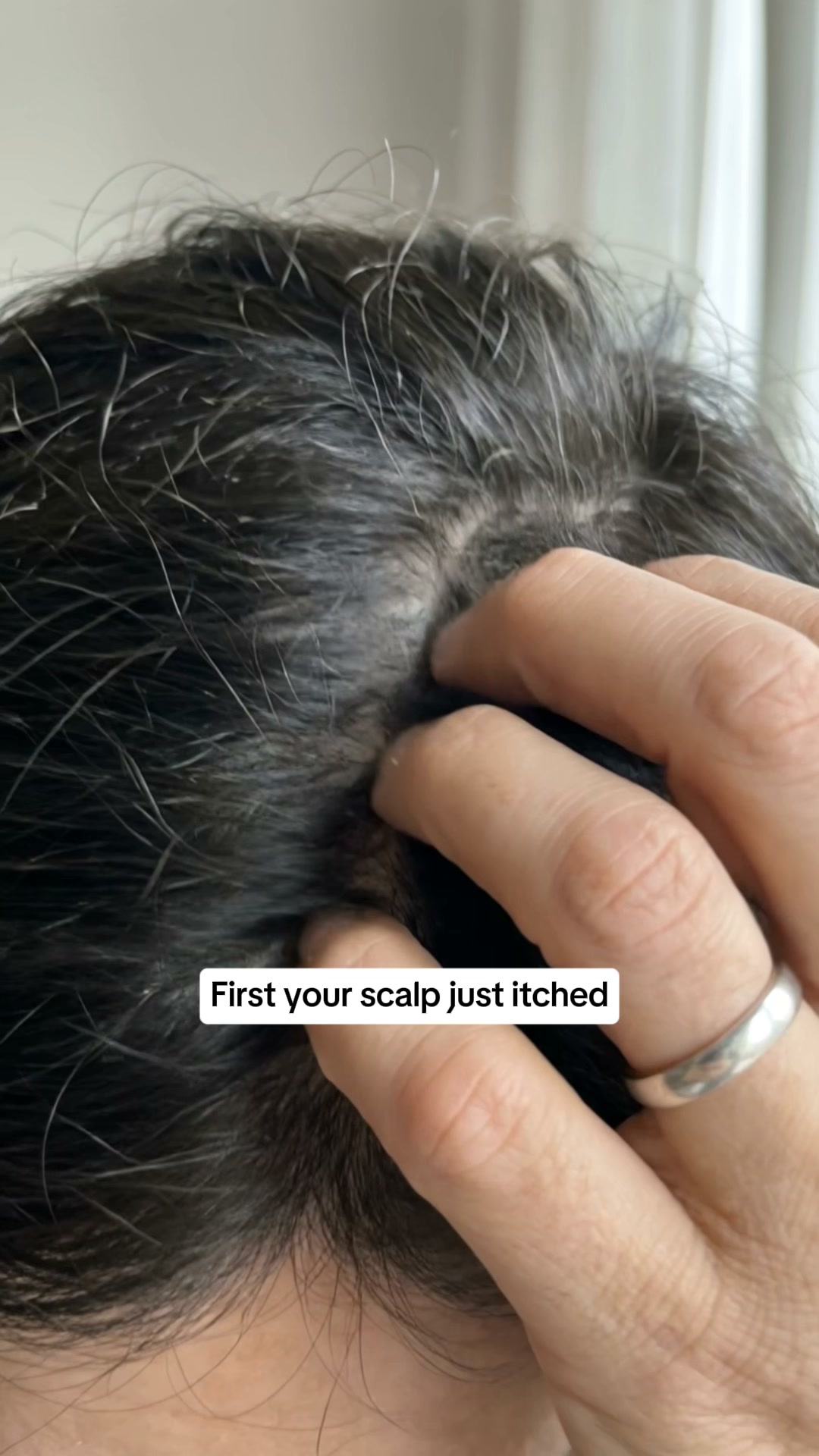 The Itch Isn't Dandruff