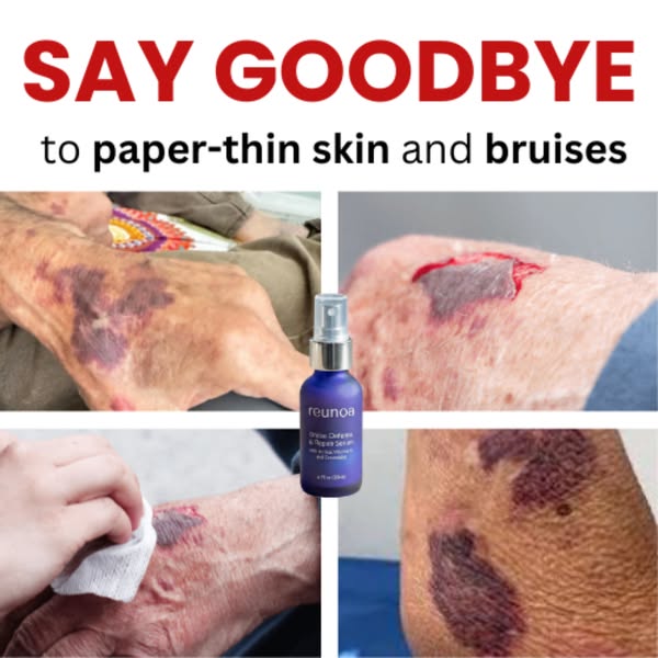 Bruises Gone In Days!