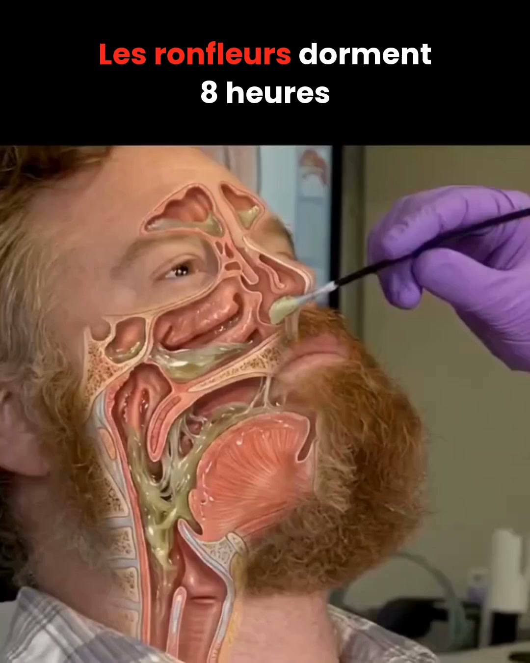 Finissez-en avec les ronflements et les nuits sans sommeil