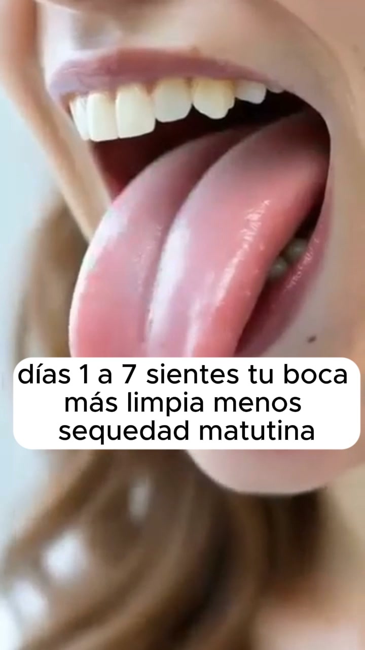 Mis piedras en las amígdalas pasaron por 6 etapas — yo me enteré en la 4 El mal aliento era la etapa 2. Yo lo ignoré por años.