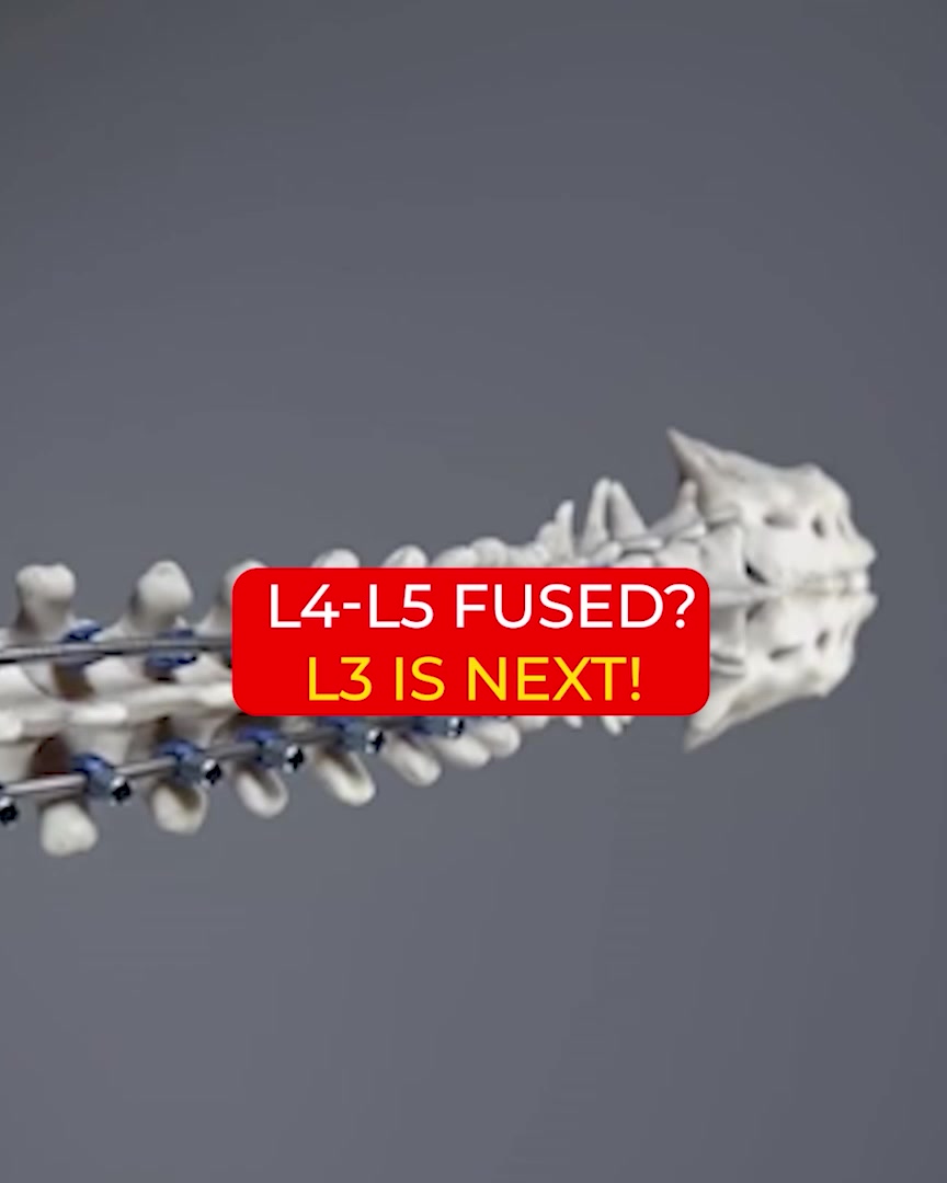 The Fusion Domino Effect Nobody Warns About Before Surgery
