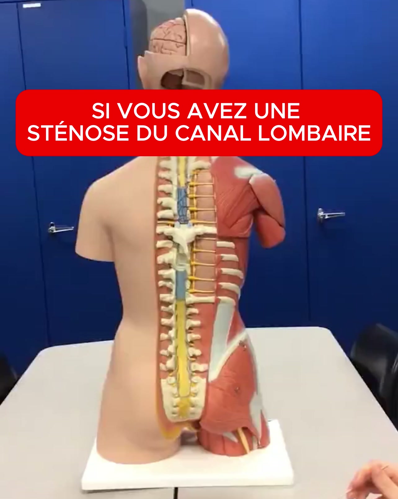 La progression de la sténose du canal lombaire a un facteur qui l'accélère
