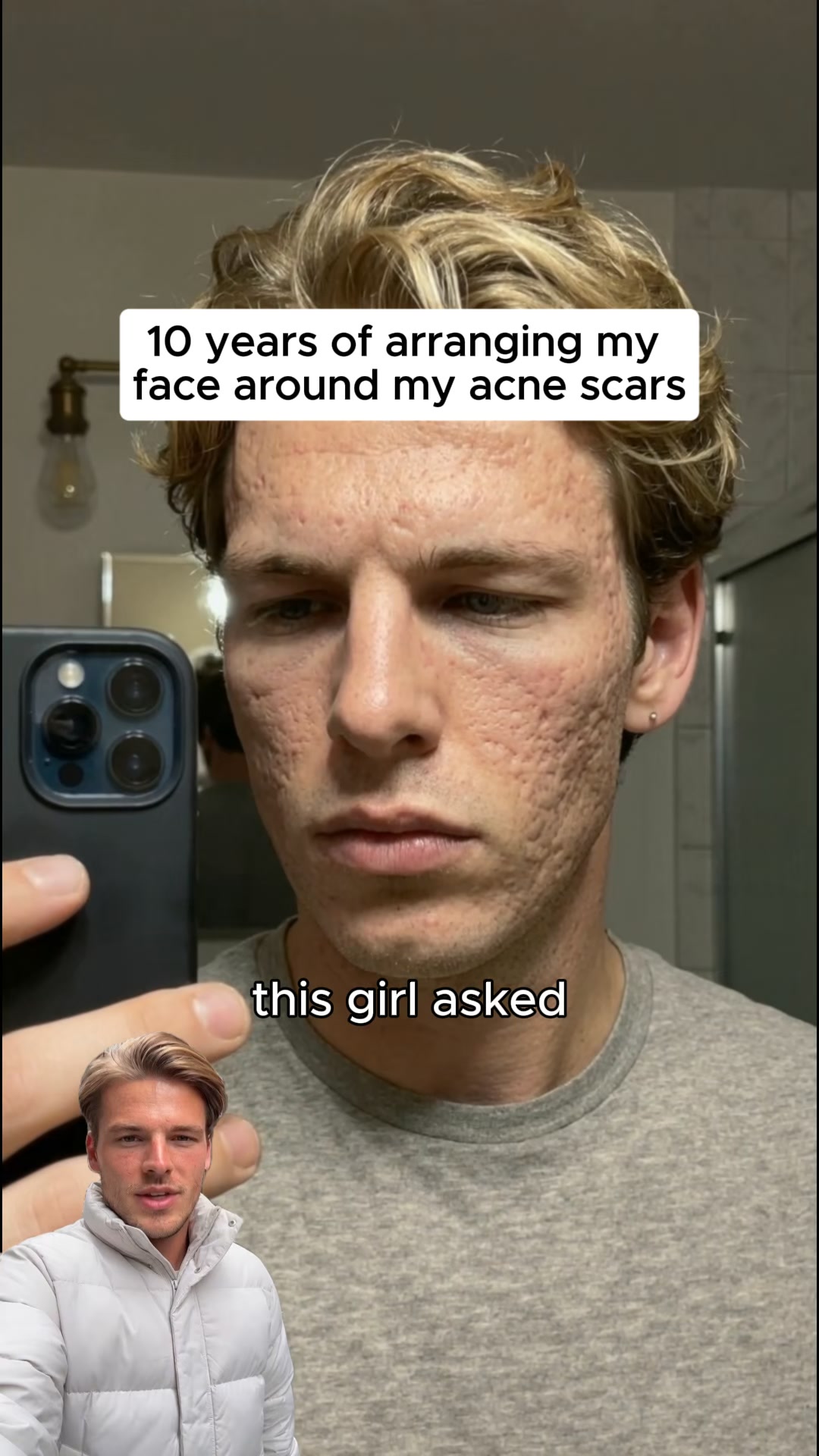 Fading Acne Scars Got Easier
