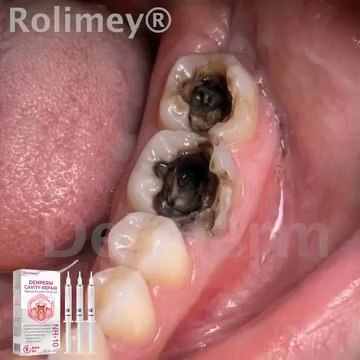 Cavity Repair | FDA-Recognized 10% Nano-Hydroxyapatite (NH-10) | Delivery Within 2–4 Business Days | Full Money-Back Guarantee