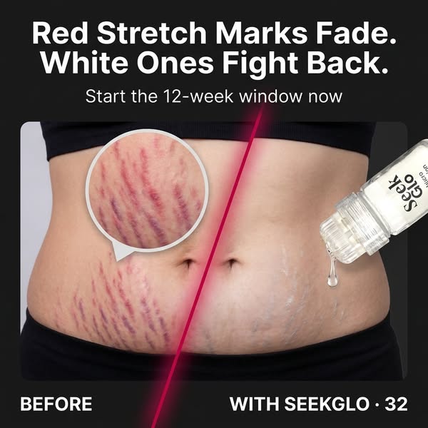 Stretch Marks? Try This At Home