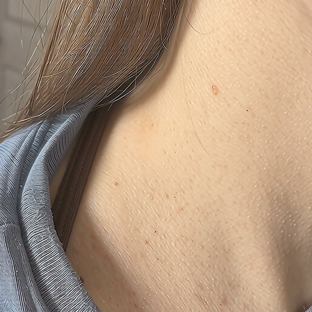 The Painless Way to Remove Skin Tags in 5 Days