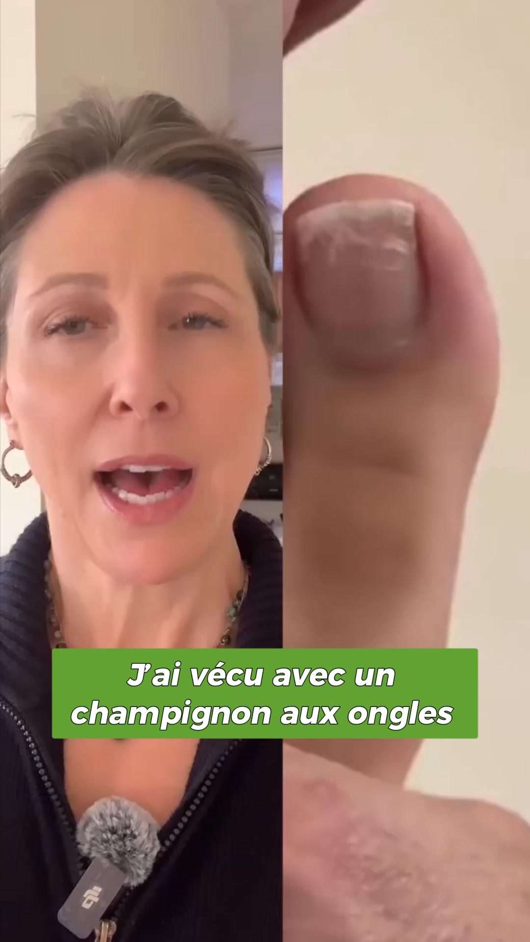 Élimine les mycoses des ongles au contact ‼