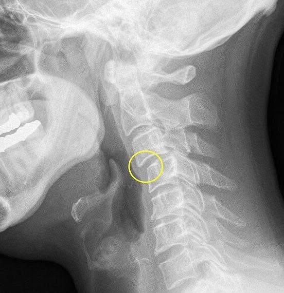 VERTIGO ISN’T JUST DIZZINESS