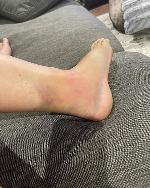 Always burning feet