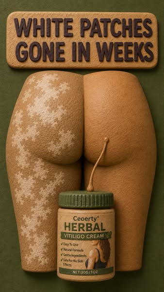 Fast and easy fix for vitiligo.