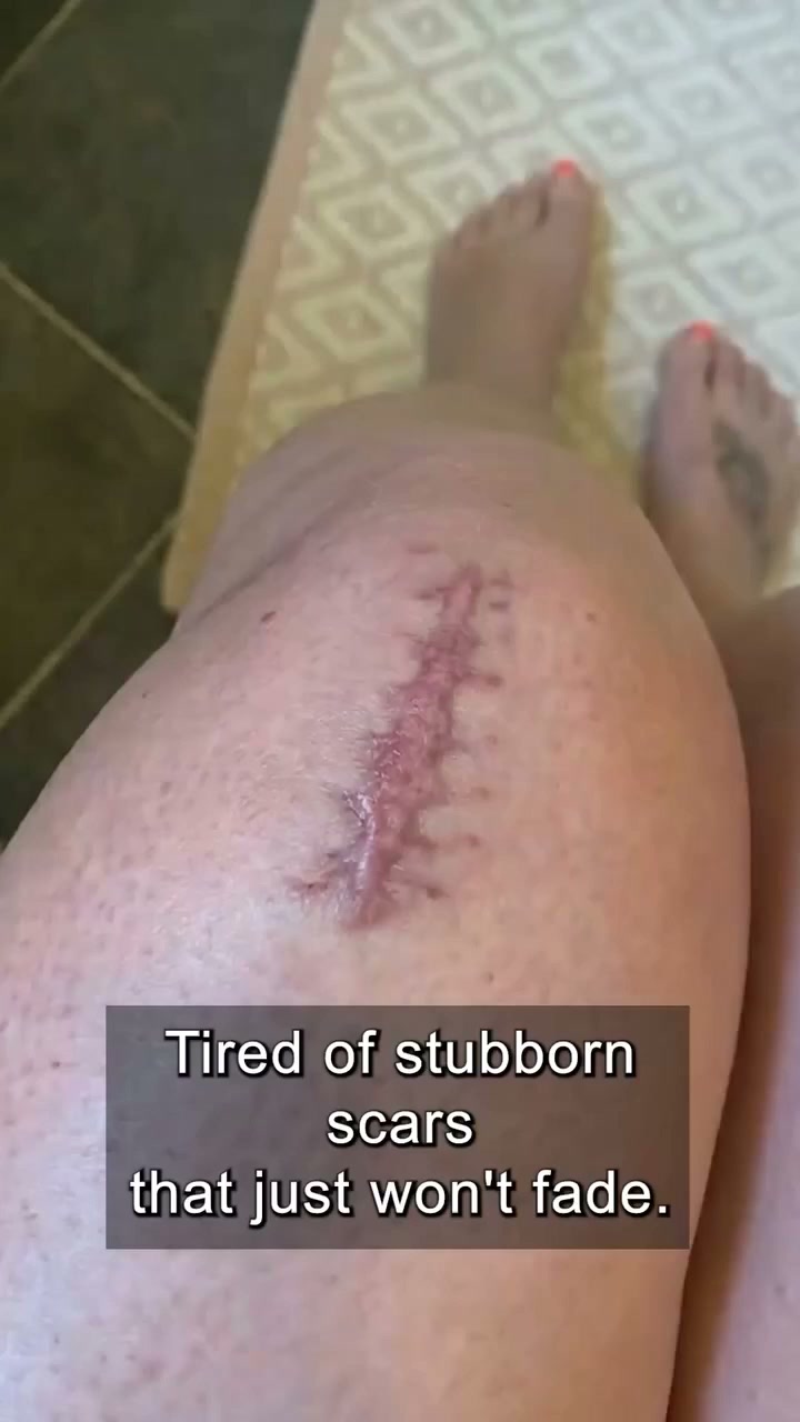 Help Your Scars Look Smoother—One Patch at a Help Your Scars Look Smoother—One Patch at a Time