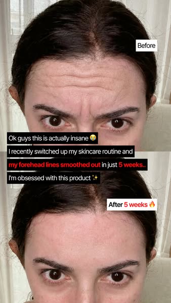 Forehead Lines Look Smoother in 5 Weeks?!