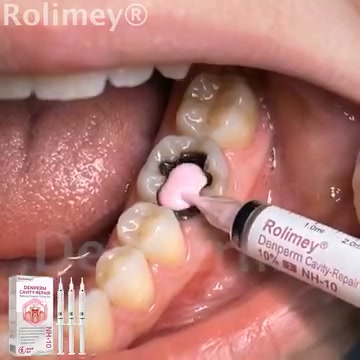Cavity Repair | FDA-Recognized 10% Nano-Hydroxyapatite (NH-10) | Delivery Within 2–4 Business Days | Full Money-Back Guarantee