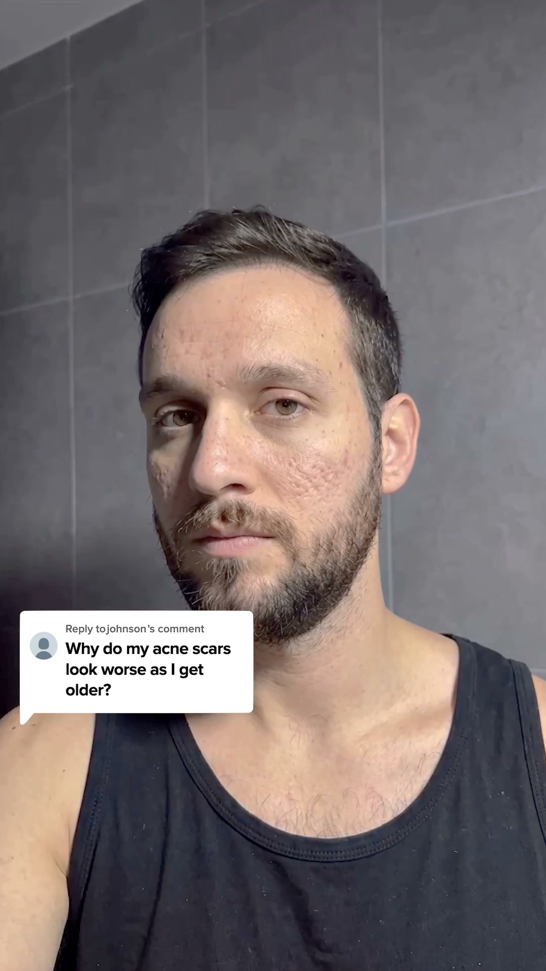 Fading Acne Scars Got Easier