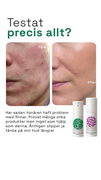 Testat allt? Upptäck Skinomes lösning för akne.