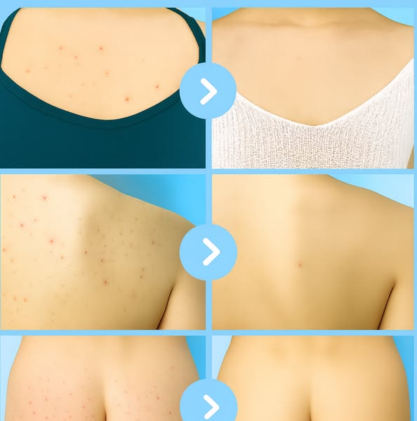 ¿Piel con impurezas en los glúteos? No estás sola.