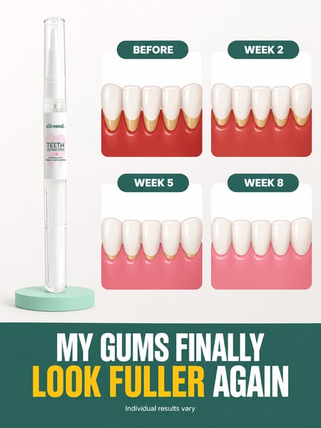 My Gums Kept Pulling Back