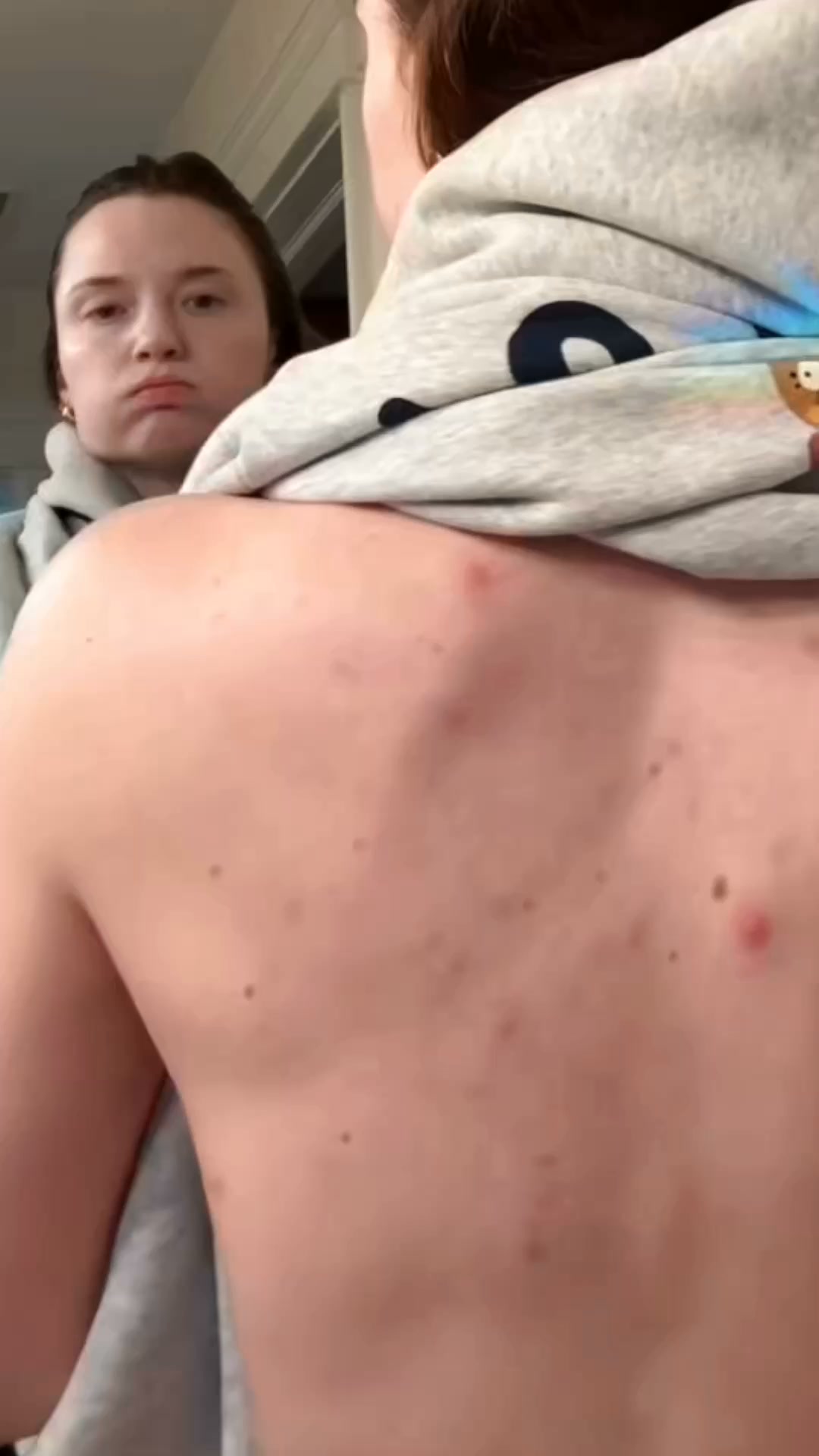 Acne, Properly Diagnosed