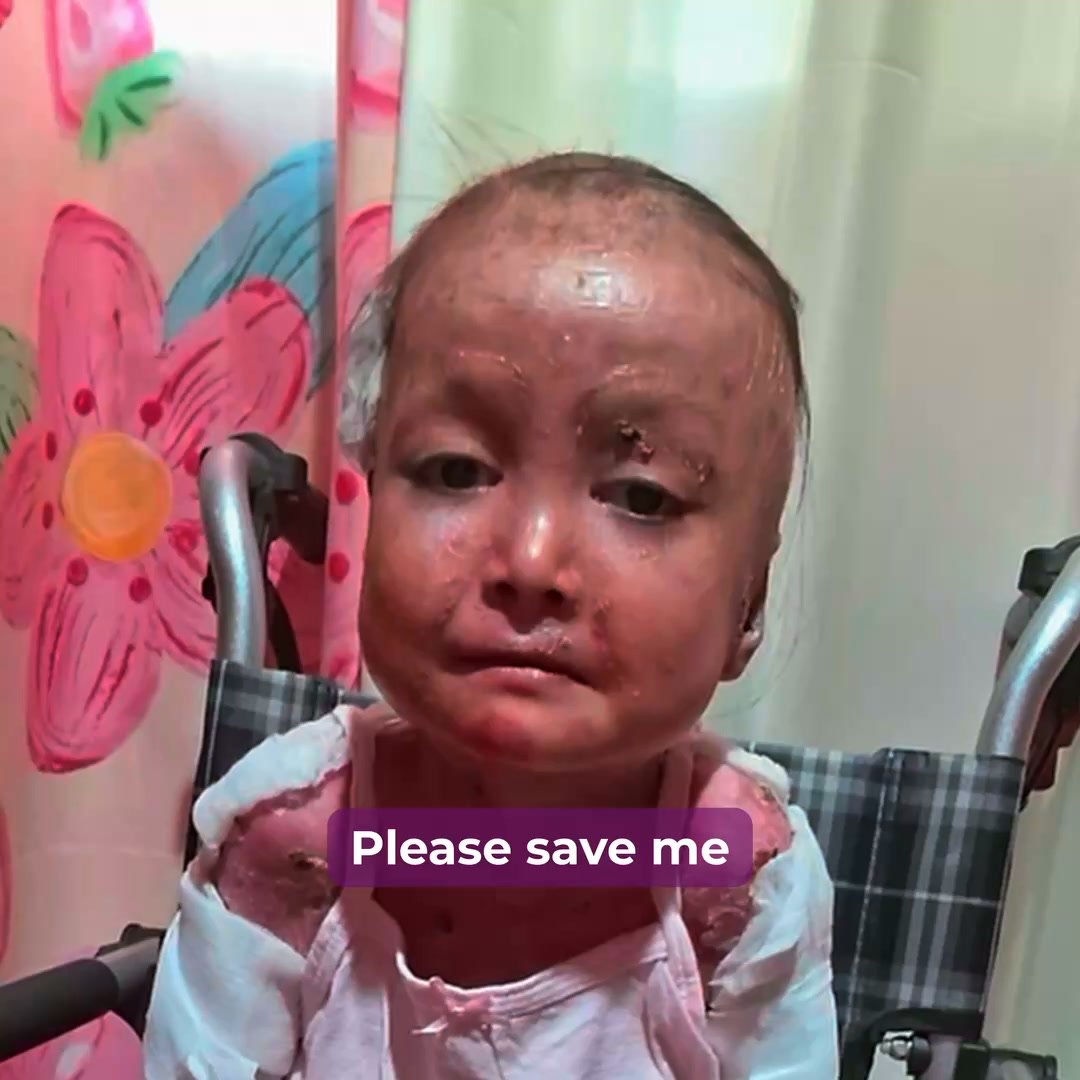 Shamila’s Skin Is Falling Off. Help Her.