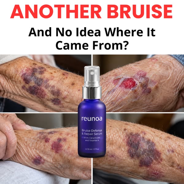 Bruises Gone In Days!
