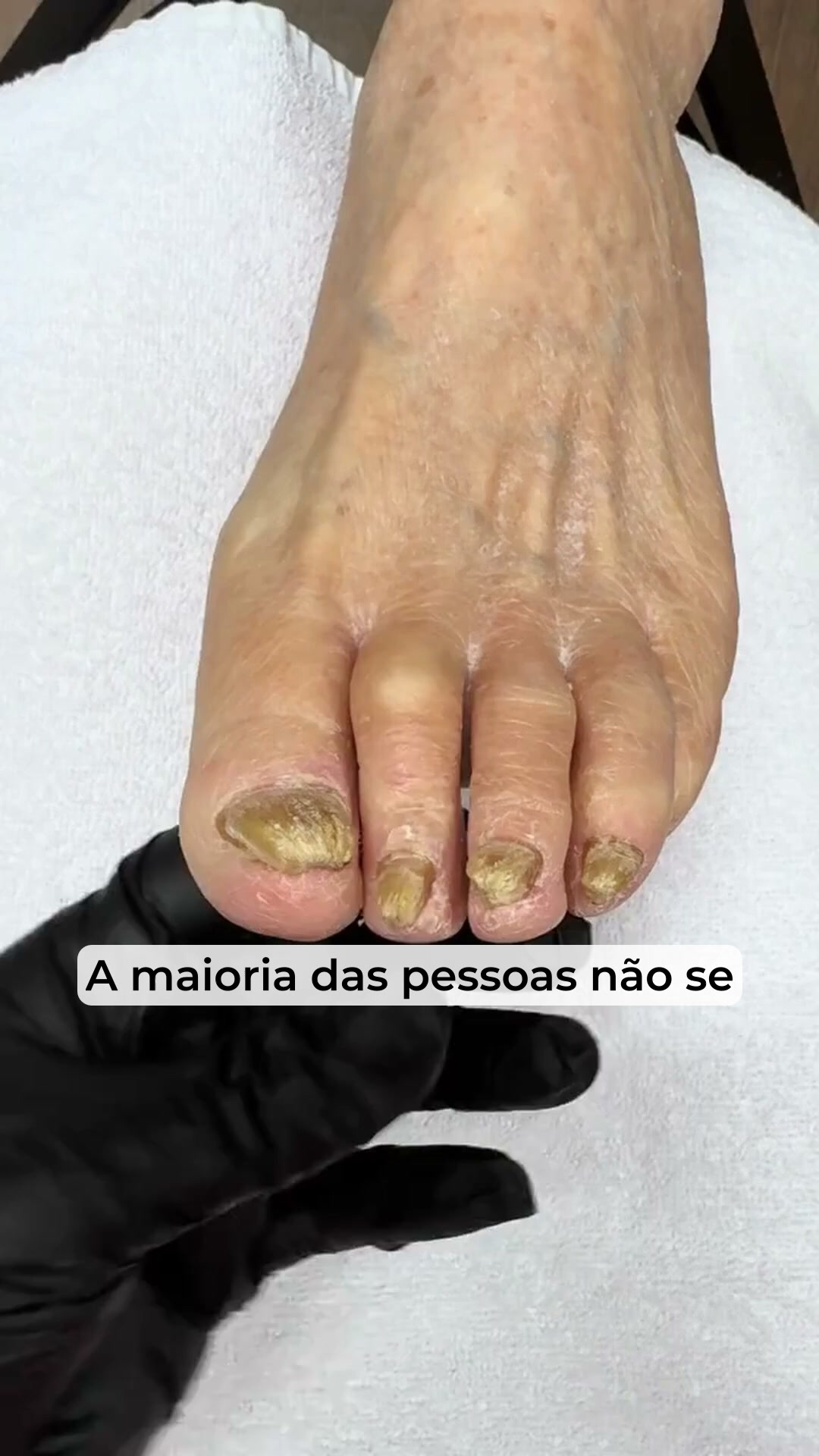 Acabe rapidamente com os fungos nas unhas.