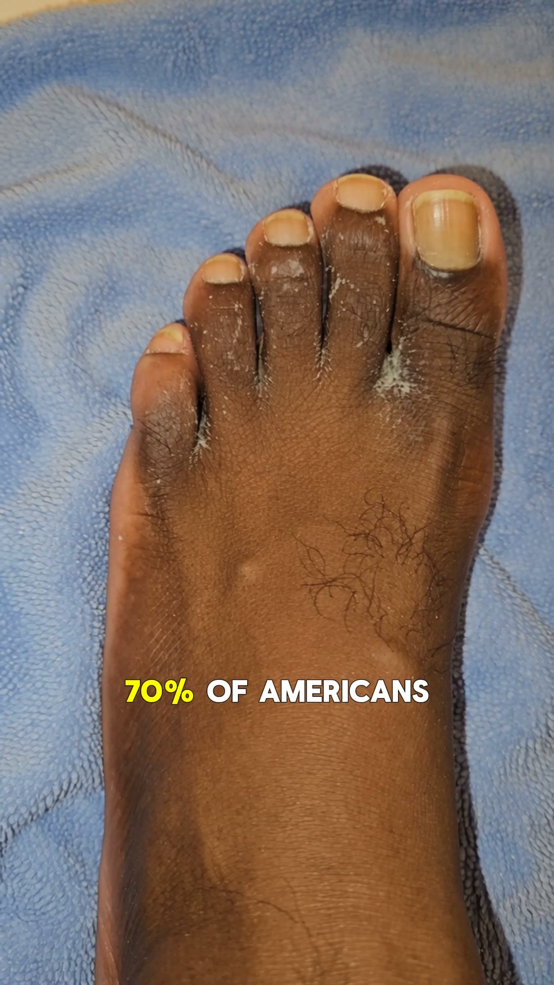 Eliminate Athlete’s Foot Today.