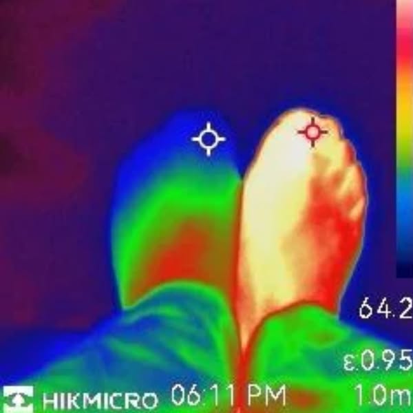 Four Years Of “Gout” Wasn’t Gout