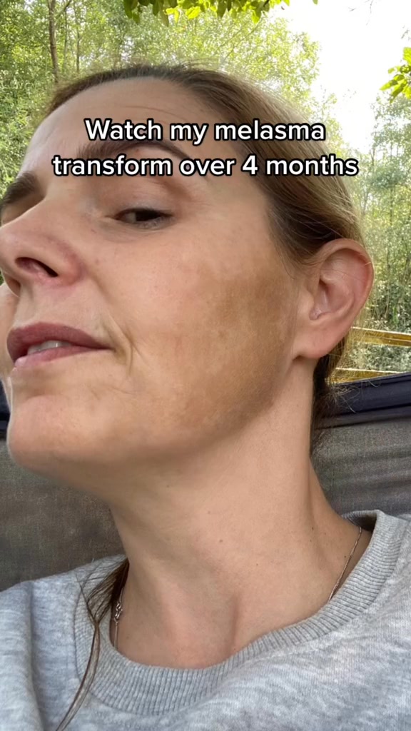 Treat melasma with a retinoids formula