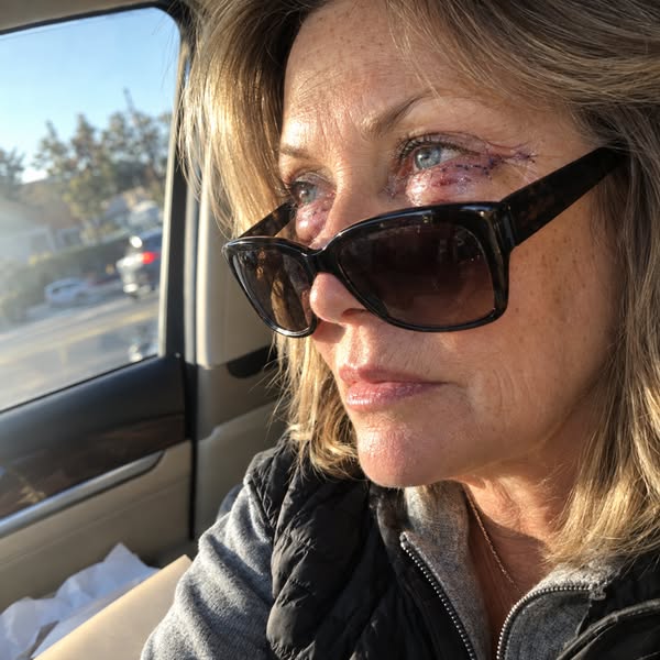 What they don’t tell you about menopause eye bags…