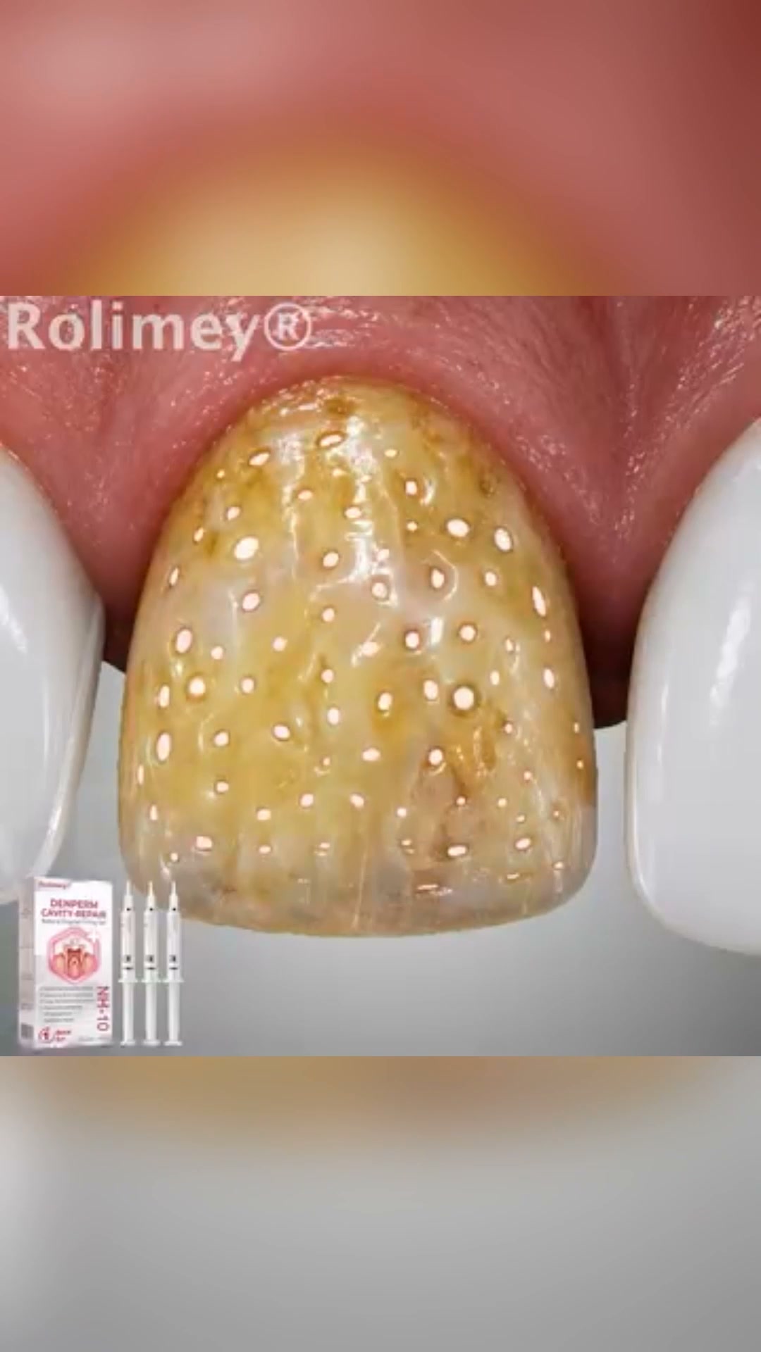 Restore Your Smile With Natural Enamel Repair Technology