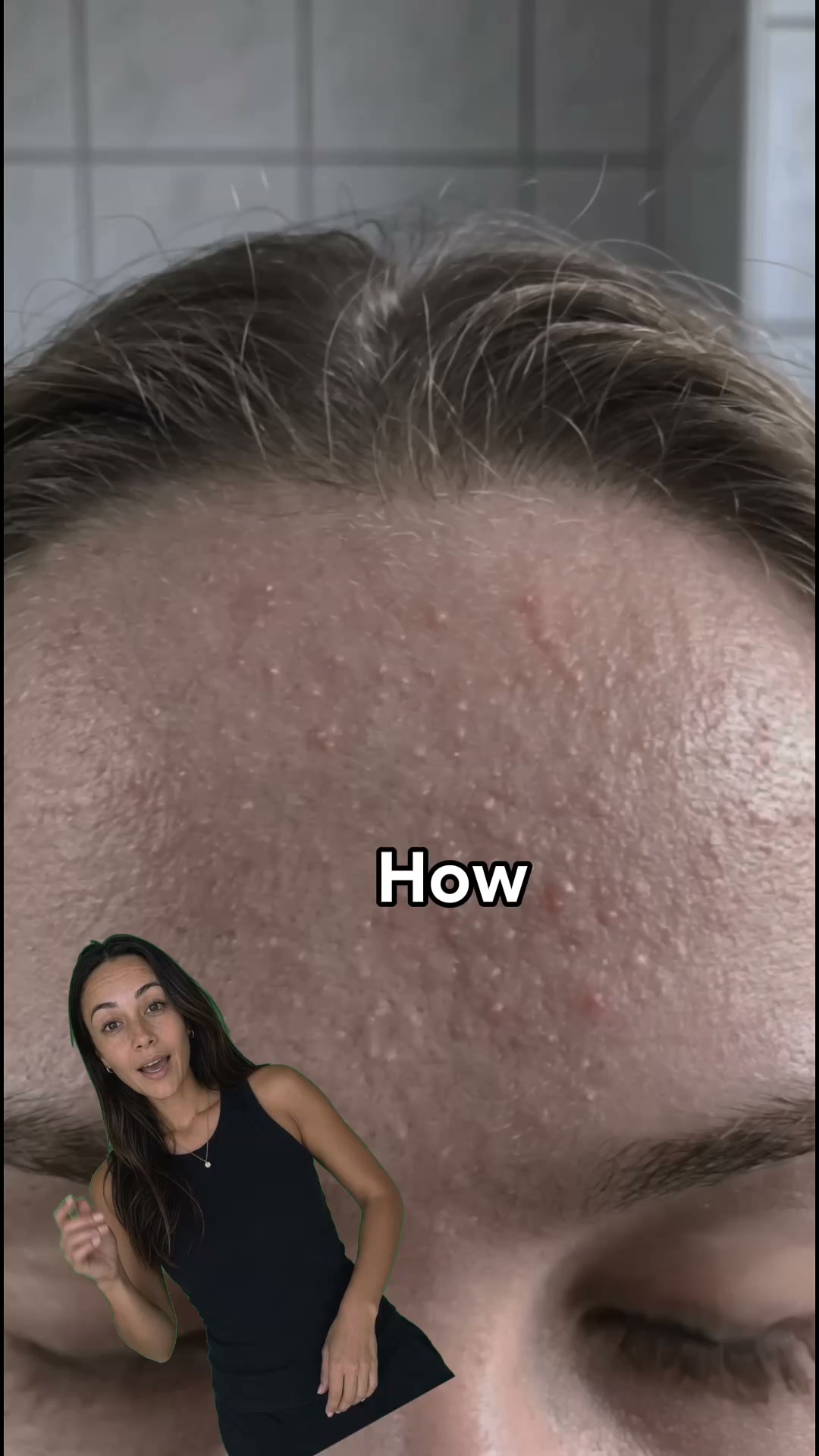 From forehead bumps to glass skin in weeks