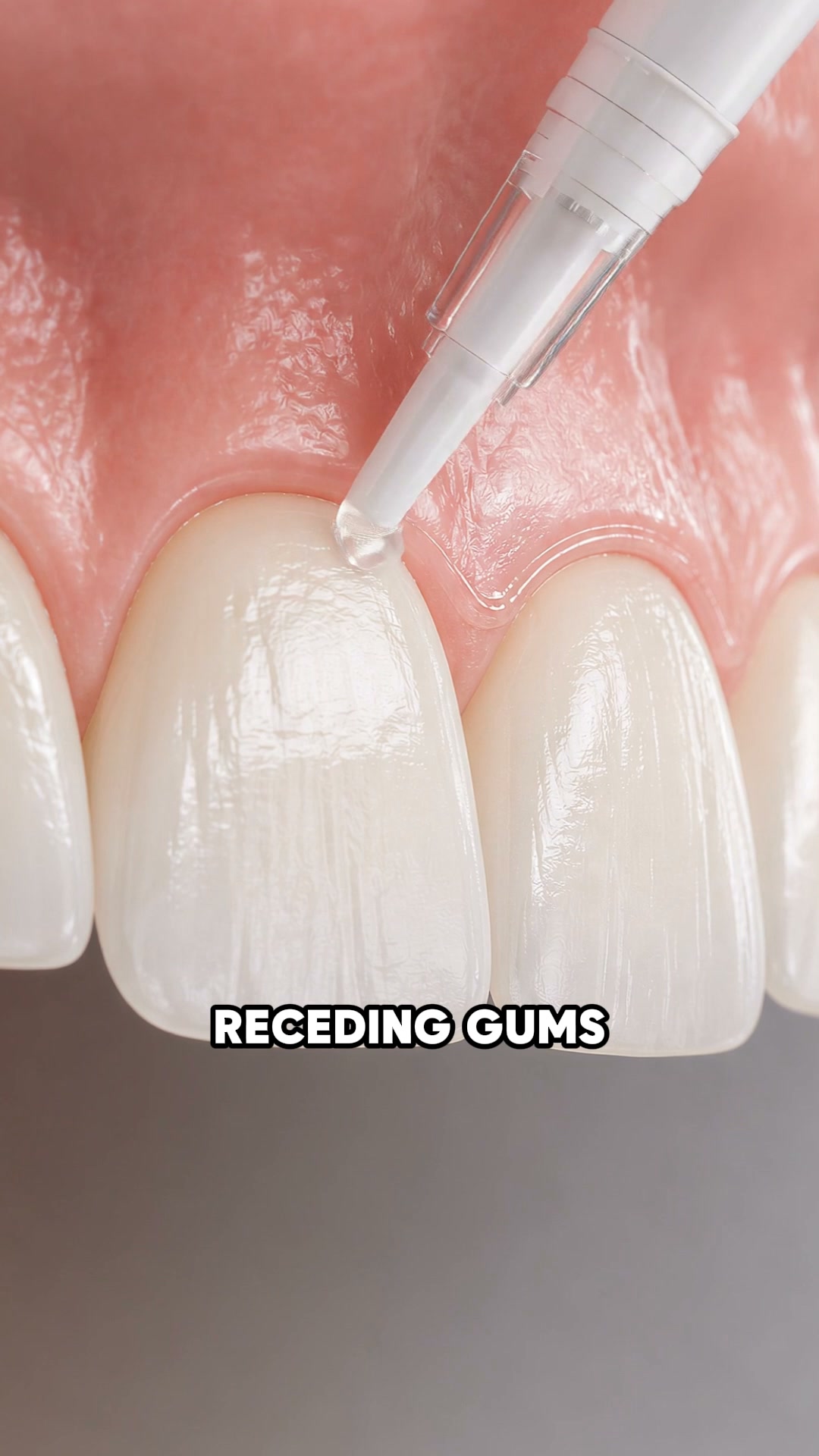 My Gums Kept Pulling Back