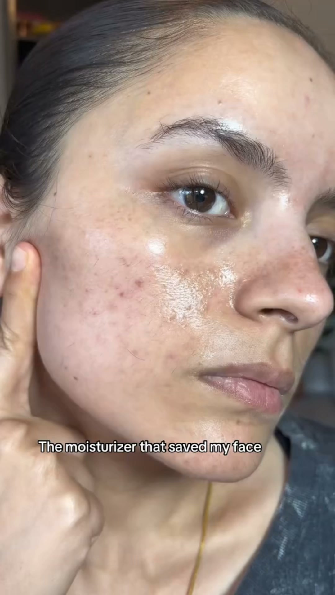 The Korean Answer To Acne’s Aftermath