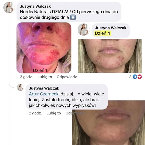 Naturalne składniki na trądzik, które umiesz wymówić
