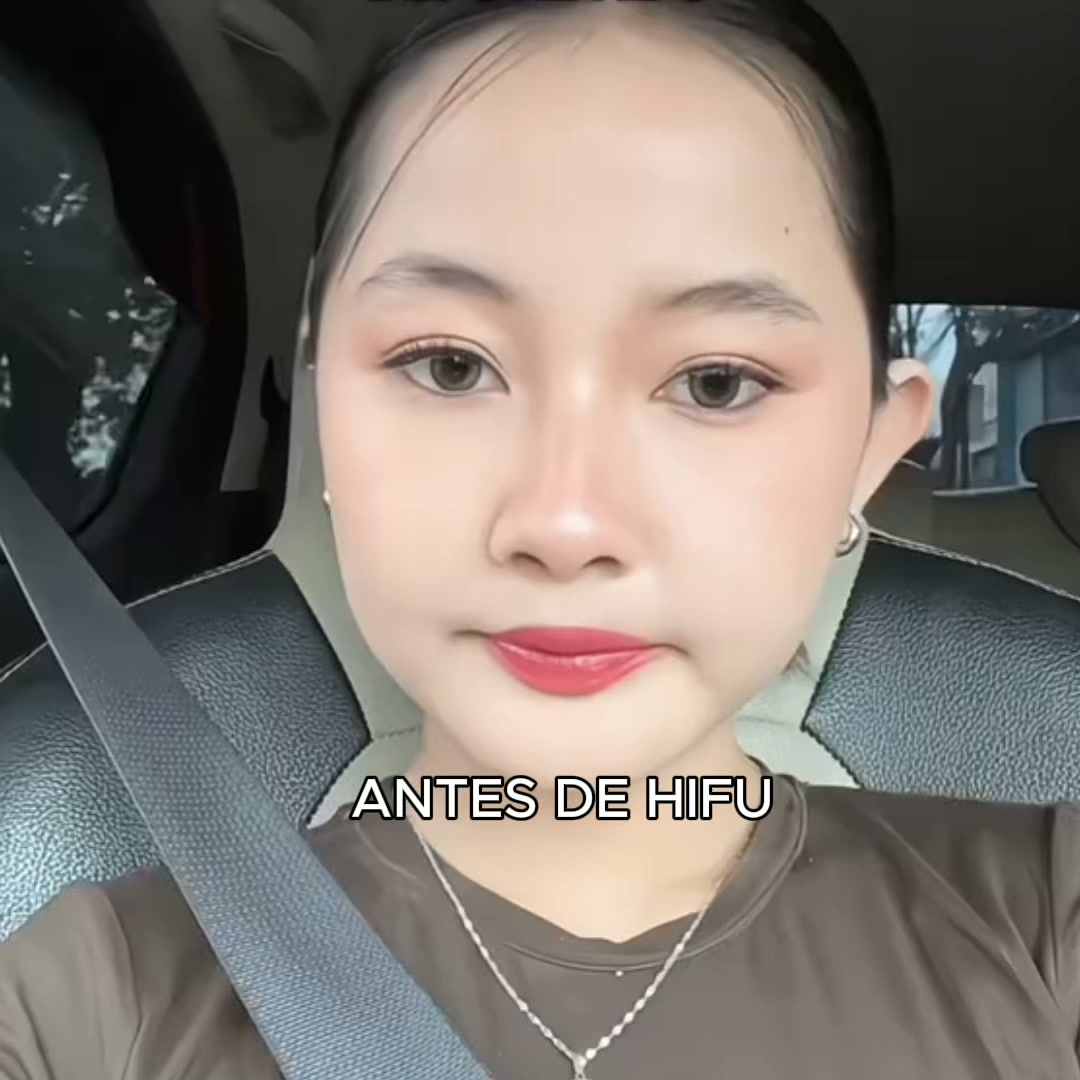 Aprende HIFU 360° Desde Cero