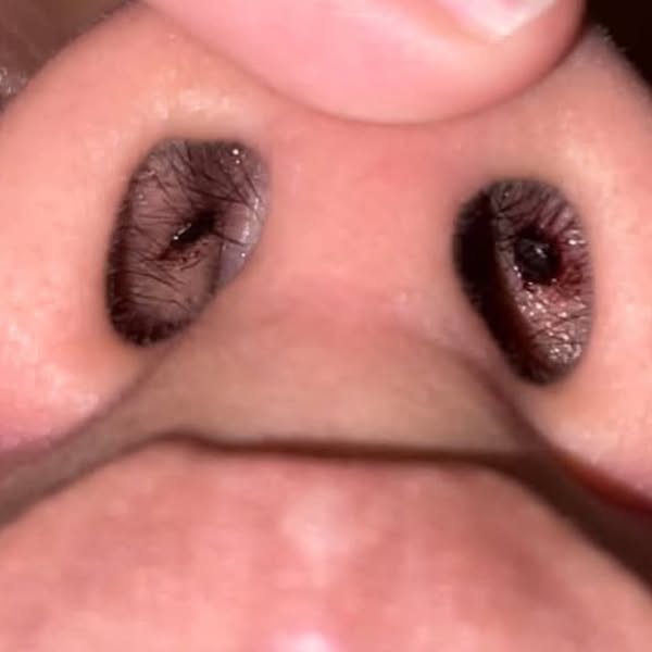 Read This If You Have Polyps