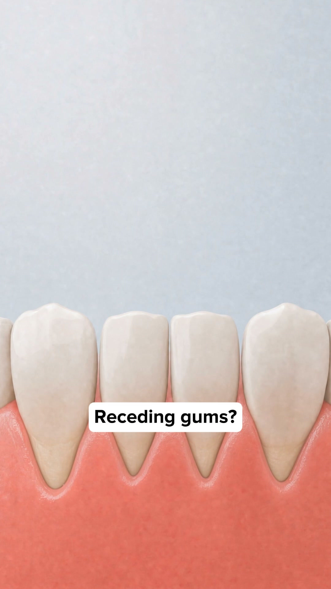 My Gums Kept Pulling Back