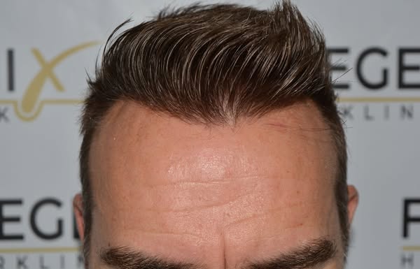 FueGenix | Exclusive Hair Transplant