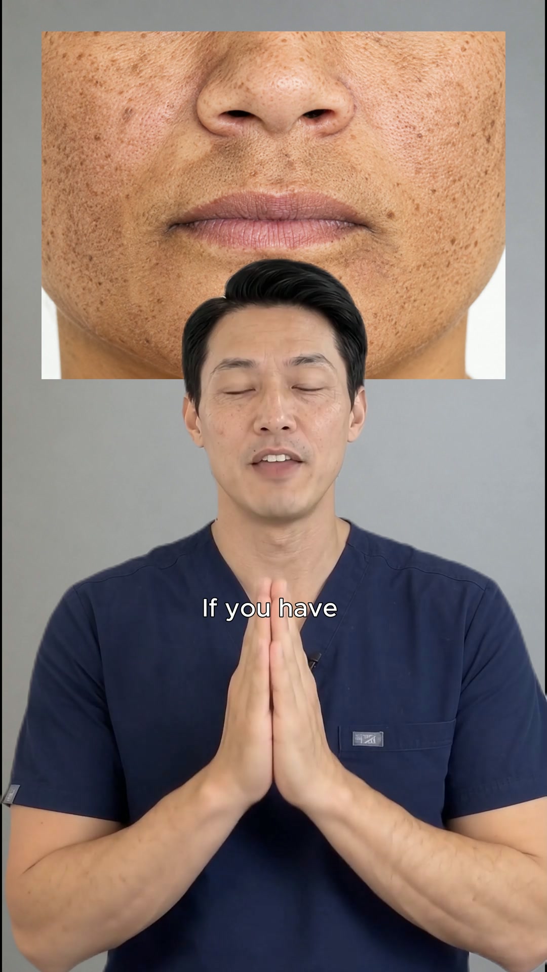 The Melasma Cream I Recommend to Every Patient