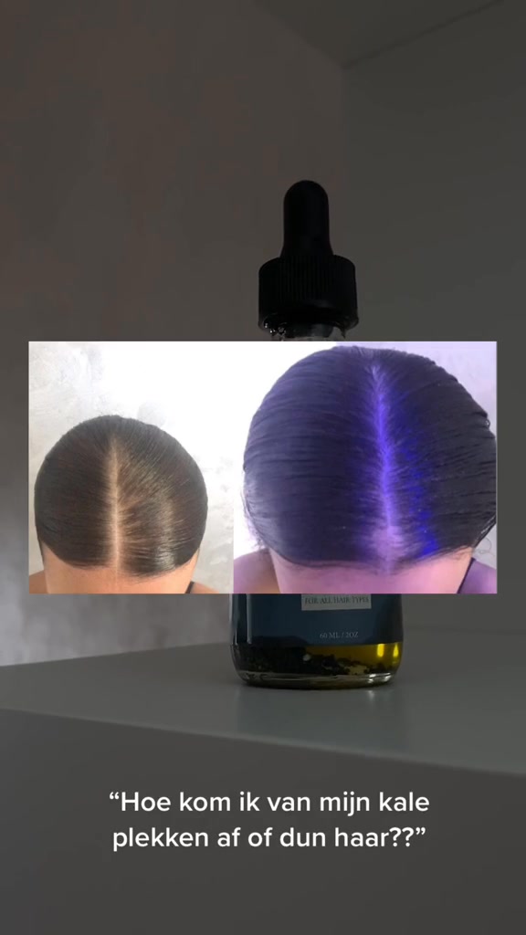 Hoe Pak Je Kale Plekken En Dun Haar Aan?