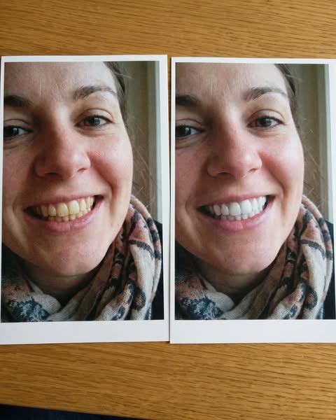 My sister watched my daughter for 3 weeks. When I got her back, her smile was different. My dentist never told me why.