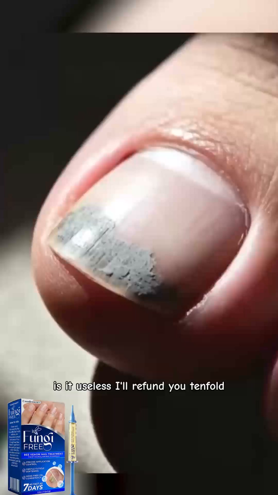 Stop Waiting for a GP | Clear Fungal Nails at Home